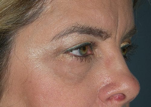 Blepharoplasty Patient 18 - Before 