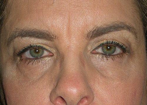 Blepharoplasty Patient 18 - Before 