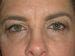 Blepharoplasty Patient 18 - Before Thumbnail 