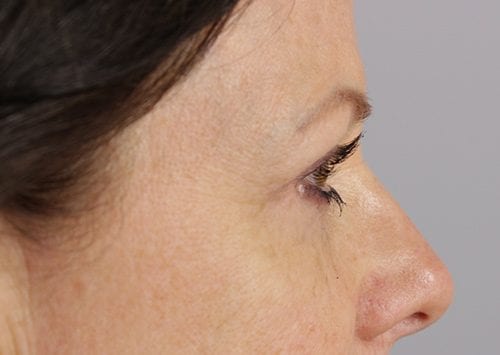 Blepharoplasty Patient 19 - After Thumbnail