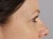 Blepharoplasty Patient 19 - After Thumbnail 