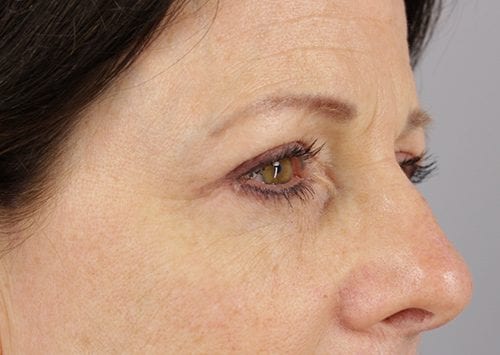 Blepharoplasty Patient 19 - After 