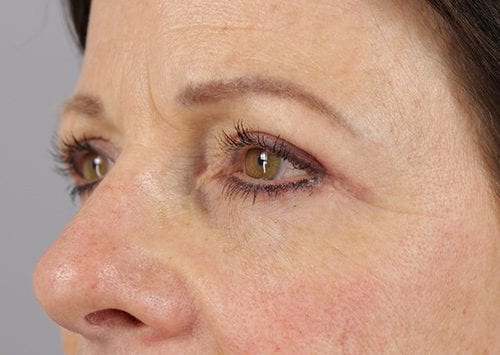 Blepharoplasty Patient 19 - After 2
