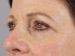 Blepharoplasty Patient 19 - After Thumbnail 