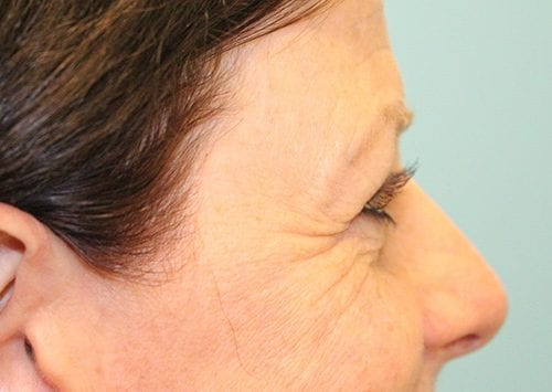 Blepharoplasty Patient 19 - Before Thumbnail