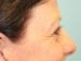 Blepharoplasty Patient 19 - Before Thumbnail 
