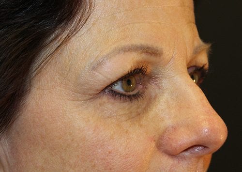 Blepharoplasty Patient 19 - Before 