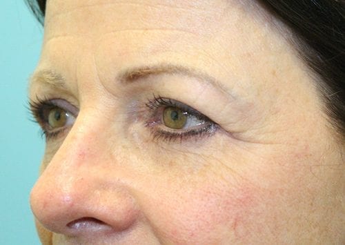Blepharoplasty Patient 19 - Before 2
