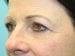 Blepharoplasty Patient 19 - Before Thumbnail 