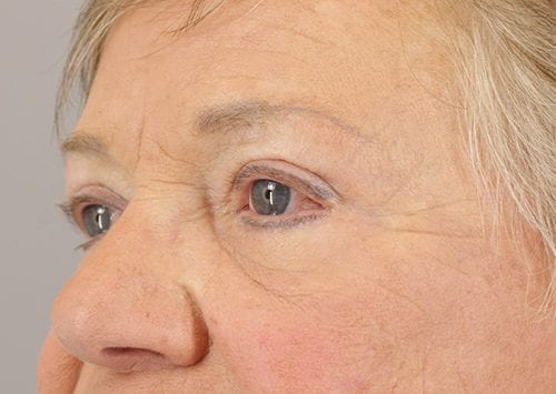 Blepharoplasty Patient 20 - After 