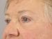 Blepharoplasty Patient 20 - After Thumbnail 