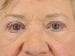 Blepharoplasty Patient 20 - After Thumbnail 