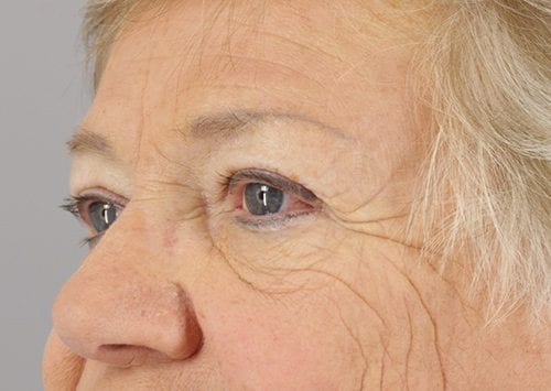 Blepharoplasty Patient 20 - Before 