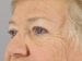 Blepharoplasty Patient 20 - Before Thumbnail 
