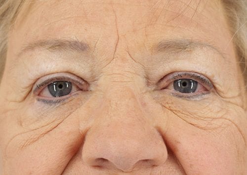 Blepharoplasty Patient 20 - Before 
