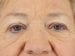 Blepharoplasty Patient 20 - Before Thumbnail 