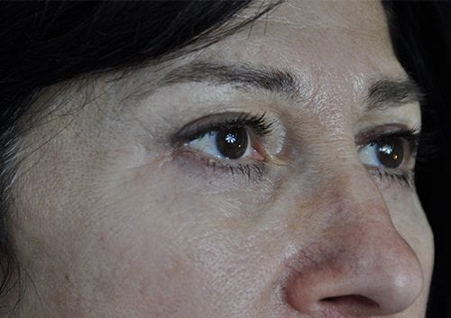 Blepharoplasty Patient 21 - After 