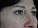 Blepharoplasty Patient 21 - After Thumbnail 