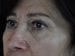 Blepharoplasty Patient 21 - After Thumbnail 