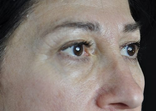 Blepharoplasty Patient 21 - Before 