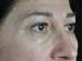 Blepharoplasty Patient 21 - Before Thumbnail 