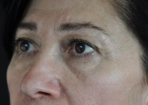 Blepharoplasty Patient 21 - Before 