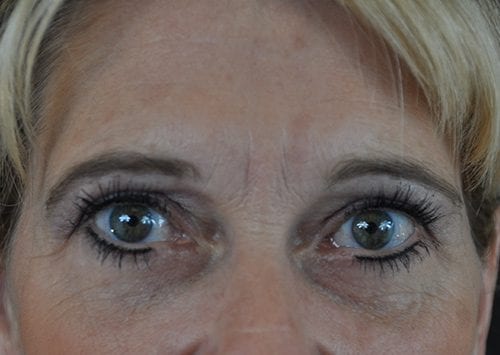 Blepharoplasty Patient 22 - After 