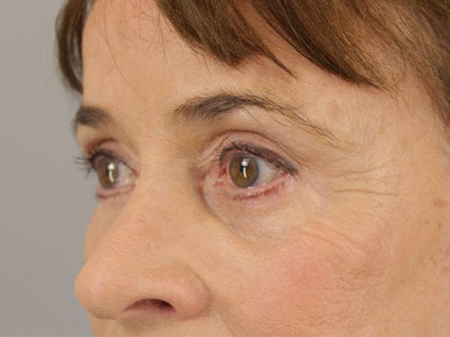 Blepharoplasty Patient 23 - After Thumbnail