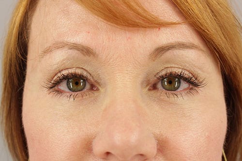 Blepharoplasty Patient 24 - After Thumbnail