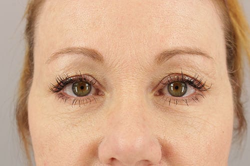 Blepharoplasty Patient 24 - Before Thumbnail