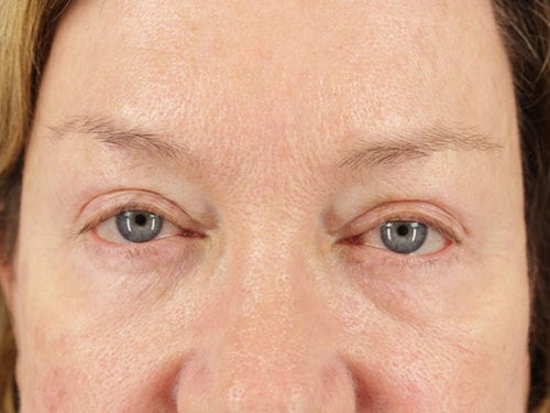 Blepharoplasty Patient 25 - After 
