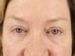 Blepharoplasty Patient 25 - After Thumbnail 