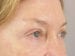 Blepharoplasty Patient 25 - After Thumbnail 