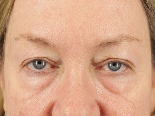 Blepharoplasty Patient 25 - Before 