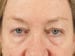 Blepharoplasty Patient 25 - Before Thumbnail 