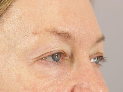 Blepharoplasty Patient 25 - Before 