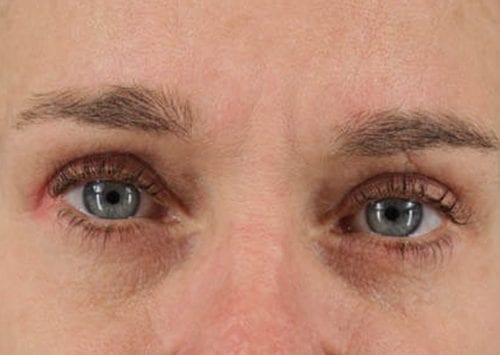Blepharoplasty Patient 03 - After Thumbnail