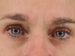Blepharoplasty Patient 03 - After Thumbnail 