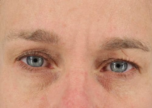 Blepharoplasty Patient 03 - Before Thumbnail