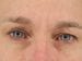 Blepharoplasty Patient 03 - Before Thumbnail 