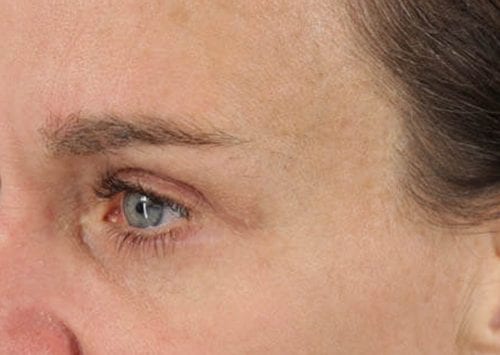 Blepharoplasty Patient 03 - After 