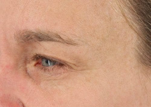Blepharoplasty Patient 03 - Before 