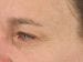 Blepharoplasty Patient 03 - Before Thumbnail 