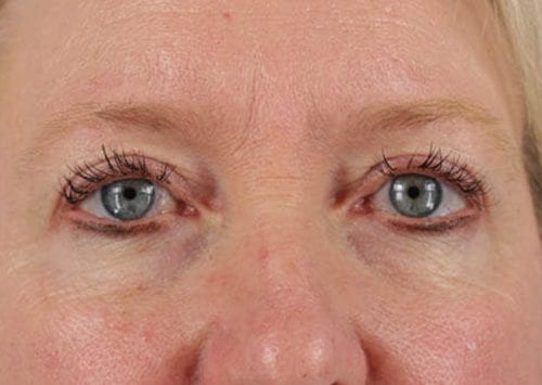 Blepharoplasty Patient 01 - After Thumbnail