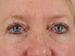 Blepharoplasty Patient 01 - After Thumbnail 