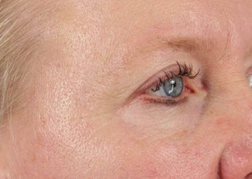 Blepharoplasty Patient 01 - After 