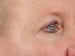 Blepharoplasty Patient 01 - After Thumbnail 