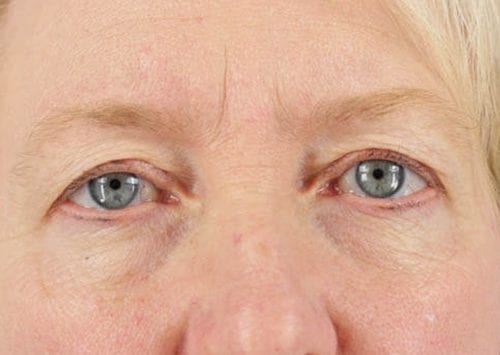 Blepharoplasty Patient 01 - Before Thumbnail