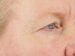 Blepharoplasty Patient 01 - Before Thumbnail 