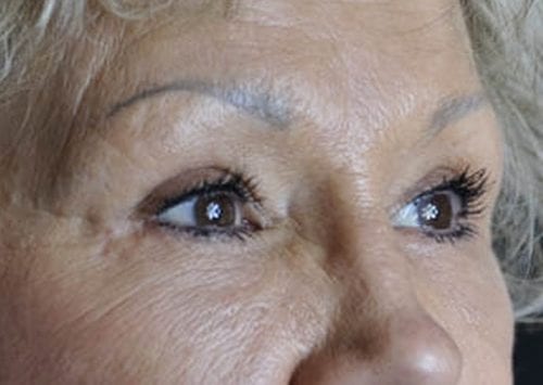 Blepharoplasty Patient 04 - After 